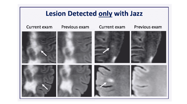 JAZZ Software Enables Better Multiple Sclerosis Lesion Detection in Record Time