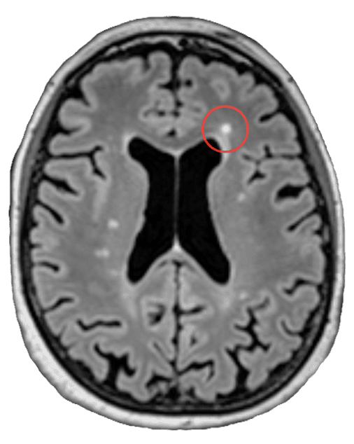 Axial FLAIR slice with a lesion circled by Jazz